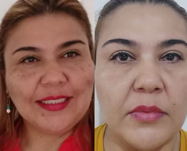 Testimonio de éxito de Patricia Medina tras tratamiento de manchas faciales en Medellín